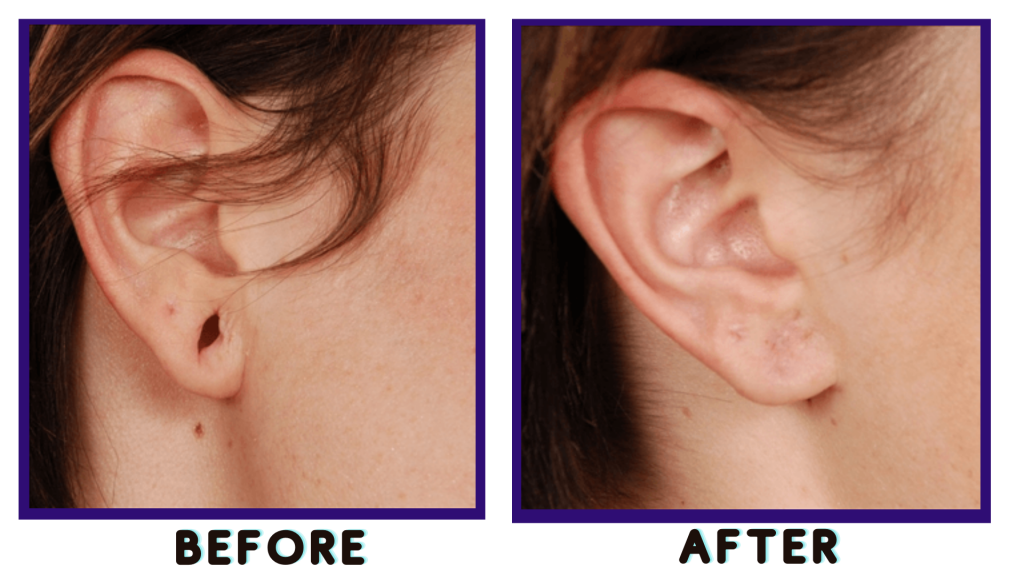 Ear Lobe